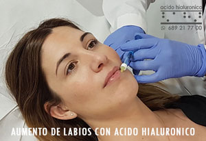Aumento de Labios con Acido Hialuronico en Madrid